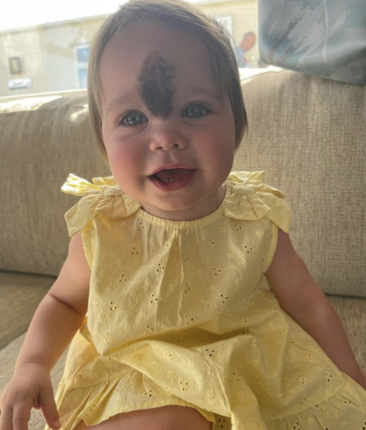 Parents’ Love Drives Them to Remove Daughter’s Birthmark