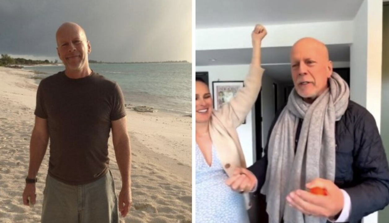 Bruce Willis’ Battle with Frontotemporal Dementia