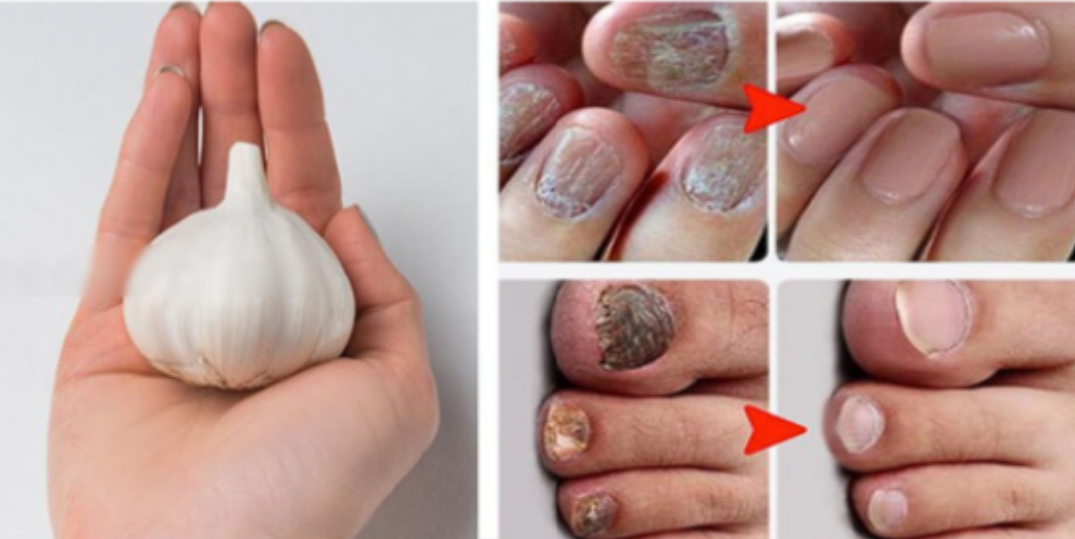 Dealing with Nail Fungus? Try Garlic!