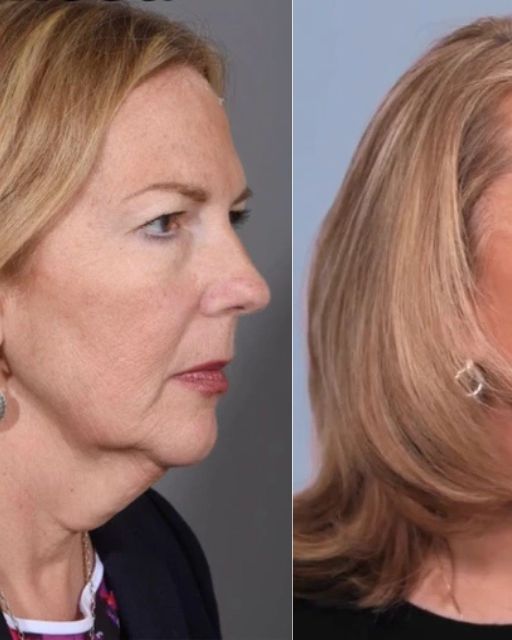 MY WIFE LOOKS 20 YEARS YOUNGER AFTER SURGERY—BUT NOW SHE DOESN’T WANT ME ANYMORE
