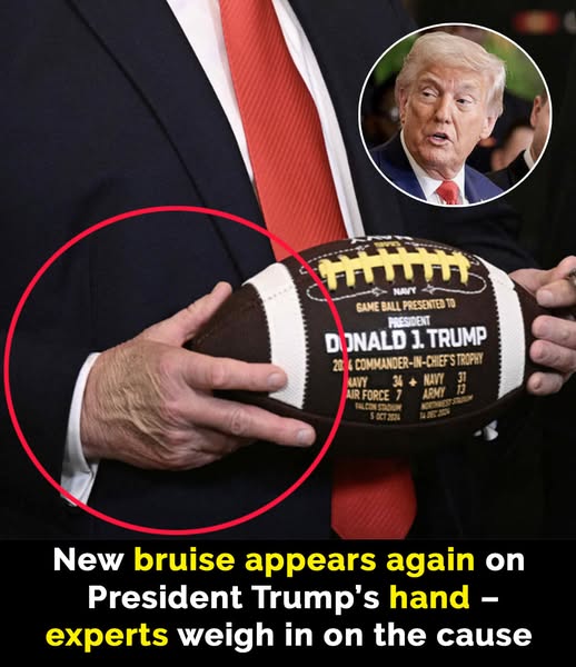 Concern Grows Over Trump’s Recurring Bruise Despite Official Explanations