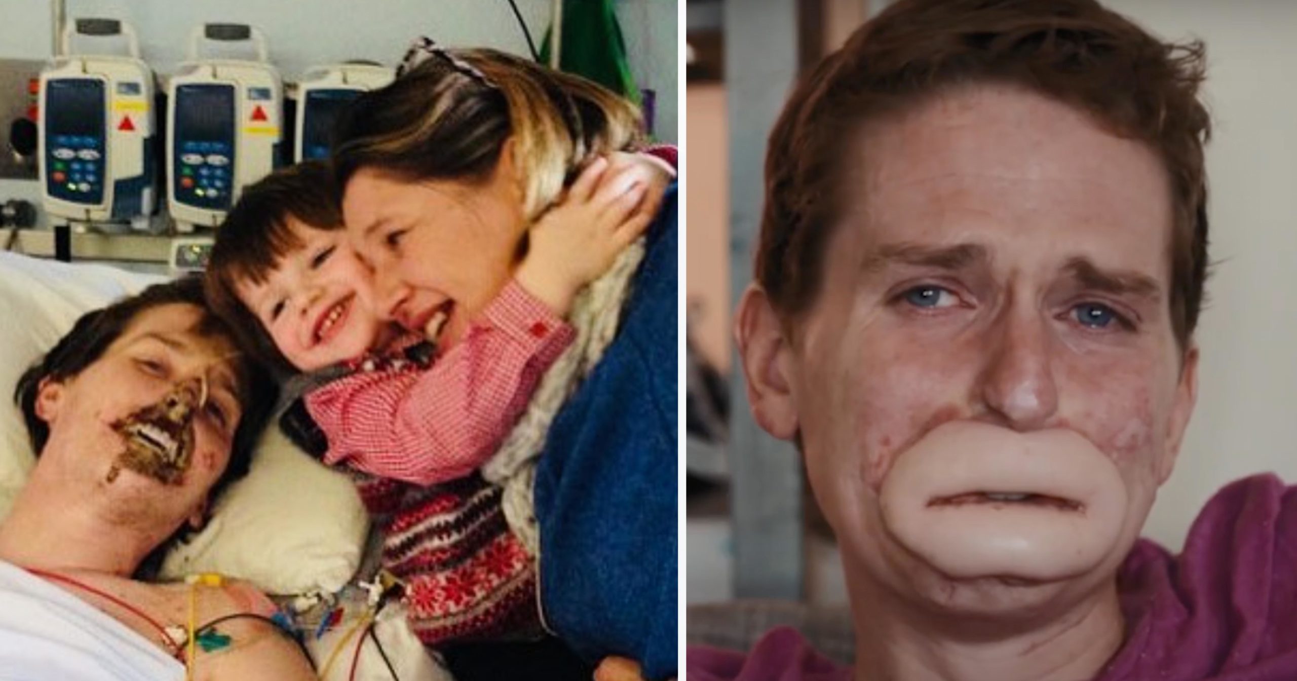 Dad Triumphs Over Flesh-Eating Bug, Living Life Fully After Losing Lips and Limbs