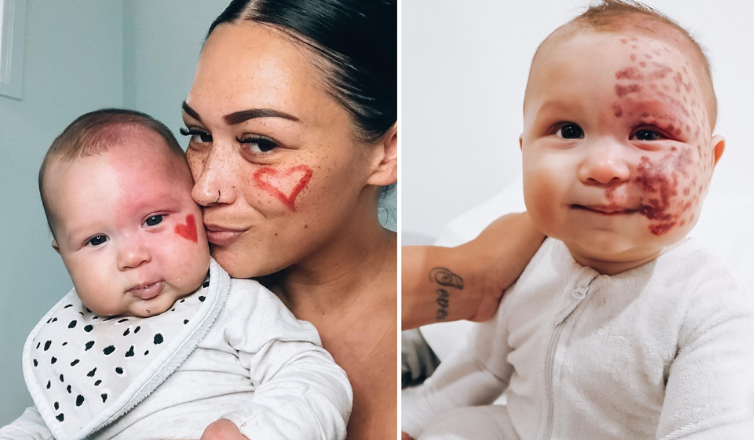 Aussie mum viciously branded a ‘monster’ by trolls for lasering birthmark on her baby’s face reveals what her son, 3, looks like now