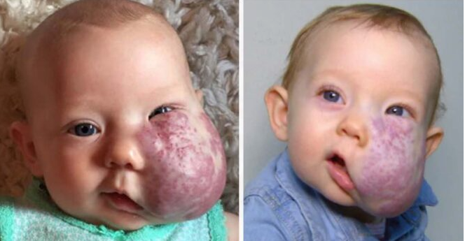 The incredible story of Sloan McGillis: She was born with a giant facial tumor – but overcame all obstacles