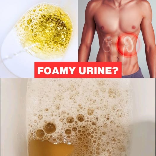 If Your Urine Is Foamy Like This, It Could Be a Warning Sign (Proteinuria)