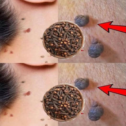 The Clove Secret: Natural Skin Tag and Wart Removal