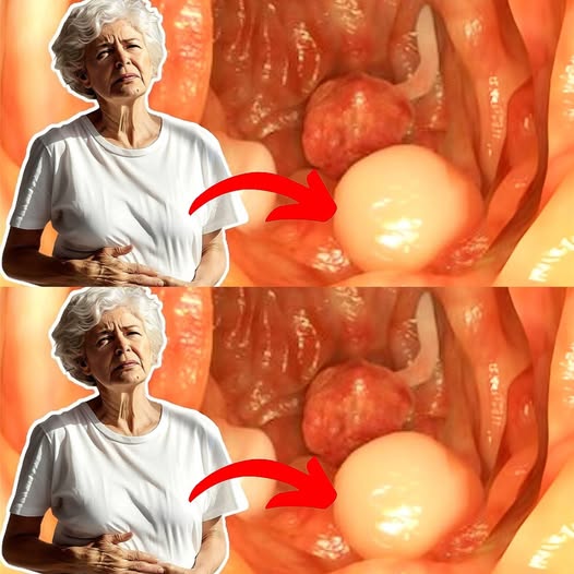 This Vitamin Can Prevent Colon Cancer – But Almost Nobody Knows It