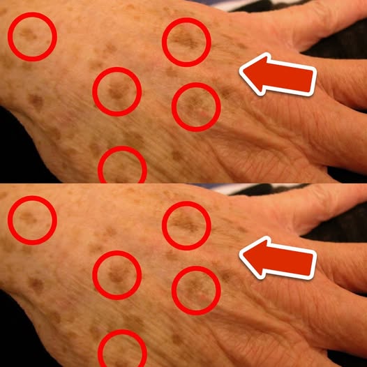 The Best Vitamin to Remove Age Spots – And How to Use It for Real Results