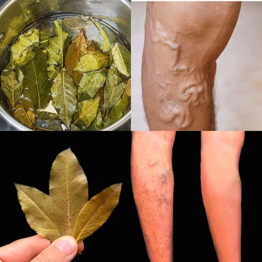 The Bay Leaf Secret: Nature’s Traditional Remedy for Varicose Veins