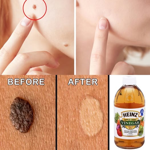How to Get Rid of Skin Moles at Home Naturally – Simple Remedies That Really Work