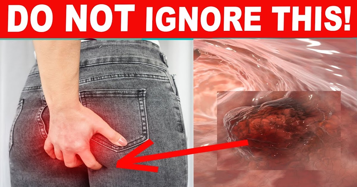 10 Colon Cancer Warning Signs You Shouldn’t Overlook
