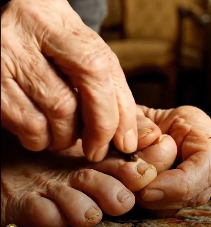 Removes Nail Fungus Instantly Like an Eraser – The Best 100% Natural Remedy (Cloves)