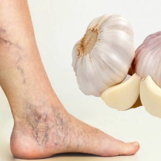 Say Goodbye to Varicose Veins with These Two Natural Recipes