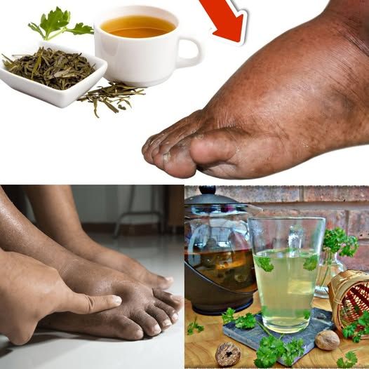 Drink this tea and you will never have swollen legs, ankles or feet again!