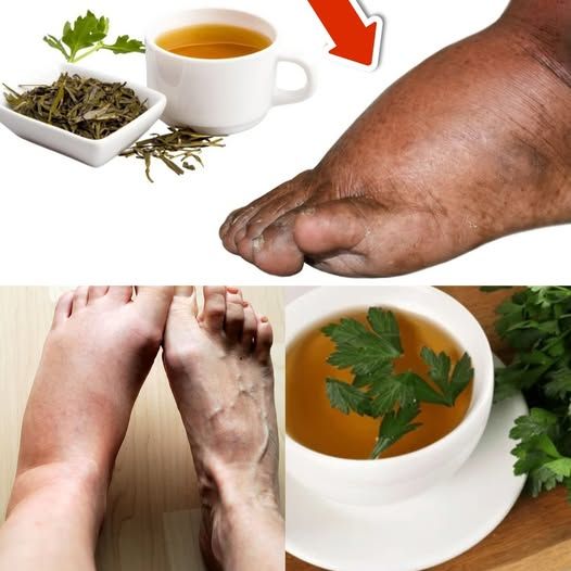 Drink This Tea and You Will Never Have Swollen Legs, Ankles or Feet Again