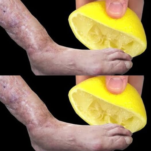Leg Pain, Rheumatism, Varicose Veins, Arthritis, Headache, Joint Pain โ My Motherโs Simple Lemon Remedy