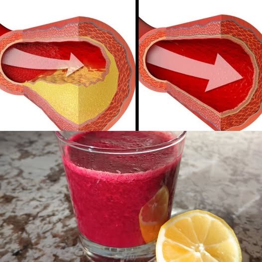 Only a Glass of This Juice Will Reverse Clogged Arteries and Lower High Blood Pressure