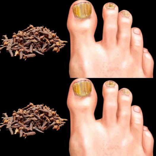 Removes Nail Fungus Instantly, Like an Eraser – The Best 100% Natural Remedy Using Cloves