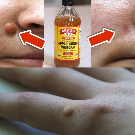 Apple Cider Vinegar Removes Warts in Just 24 Hours
