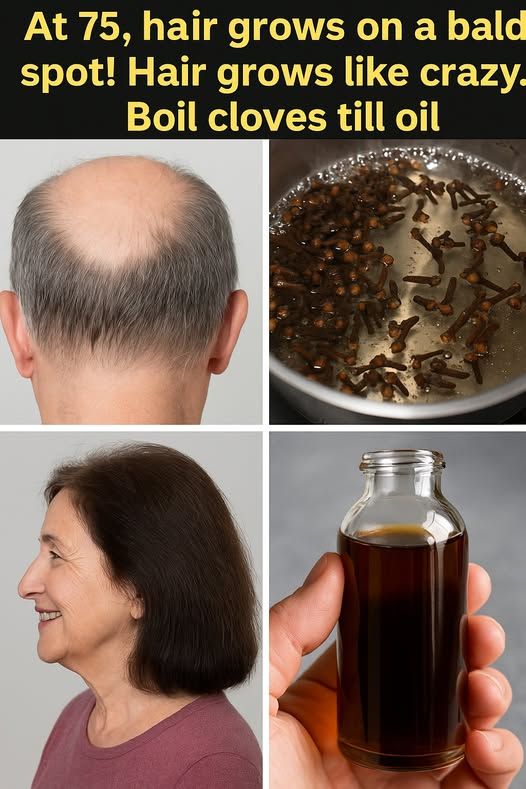 At 75, hair grows on a bald spot! Hair grows like crazy.