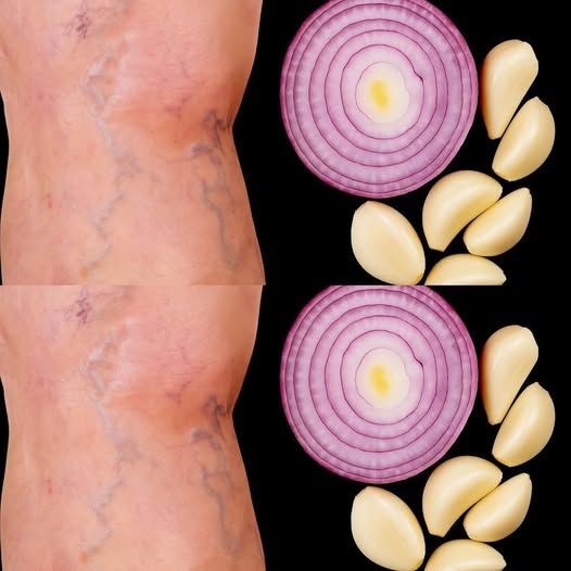 2 Natural Fixes That Erased My Varicose Veins! You Won’t Believe It!