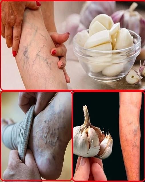 My Mother Taught Me This Secret: The Remedy That Cures Leg Pain, Rheumatism, Varicose Veins, Arthritis, Headache, Joint Pain