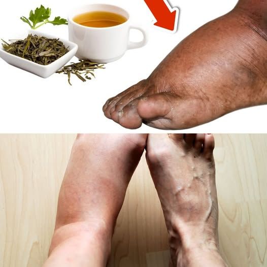 Drink This Tea and You Will Never Have Swollen Legs, Ankles, or Feet Again!