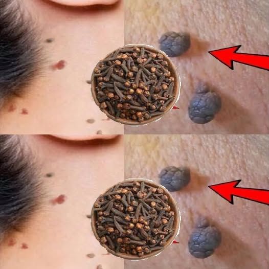 Cloves Remove Skin Tags and Warts in One Night | How to Remove Skin Tags?