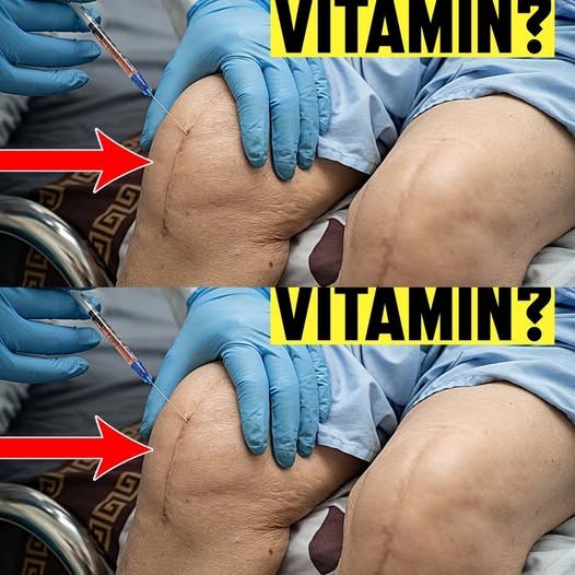 The most powerful VITAMINS that will save your knees from surgery!