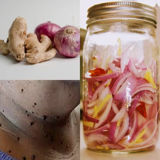 Ginger Oil to Remove Skin Tags in One Night Naturally | Homemade Skin Tag Removal Remedies