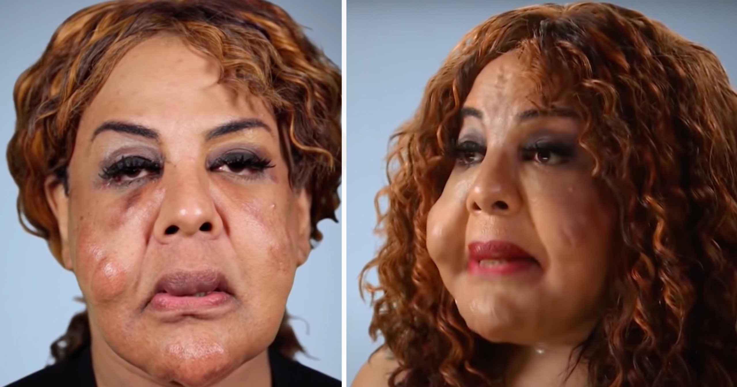 Black‑market ‘doctor’ injected cement into her face — how Rajee Narinesingh rebuilt her life