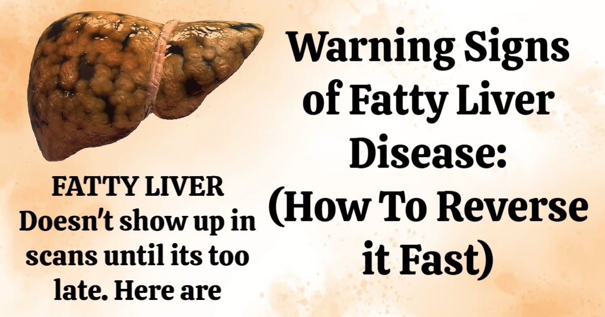 Warning Signs of Fatty Liver Disease: How To Reverse it Fast