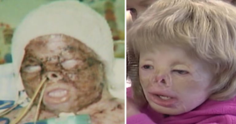 Terri Calvesbert Survived 90% Burns as a Baby — The Remarkable Woman She Is Today
