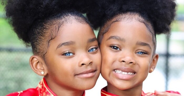 It’s Been 12 Years: See the Twin Sisters with Different-Colored Eyes Today