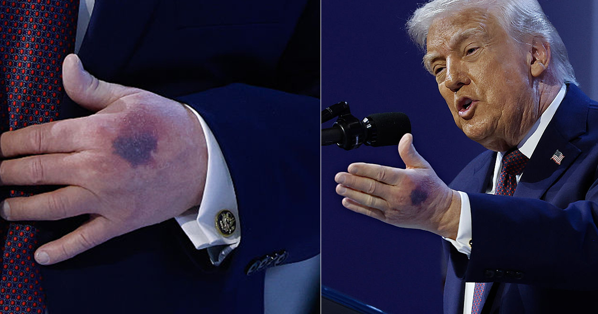 Trump explains the heavy bruise on his left hand came from โclipped it on the tableโ