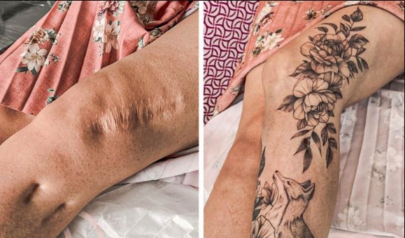 Transforming Scars into Something Beautiful with Tattoos