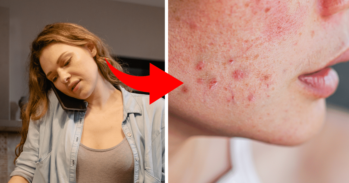 8 Places Acne Shows Up And What Might Be Causing Each One