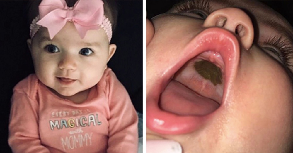 Panic: Mom Notices Dark Spot in Her Baby’s Mouth
