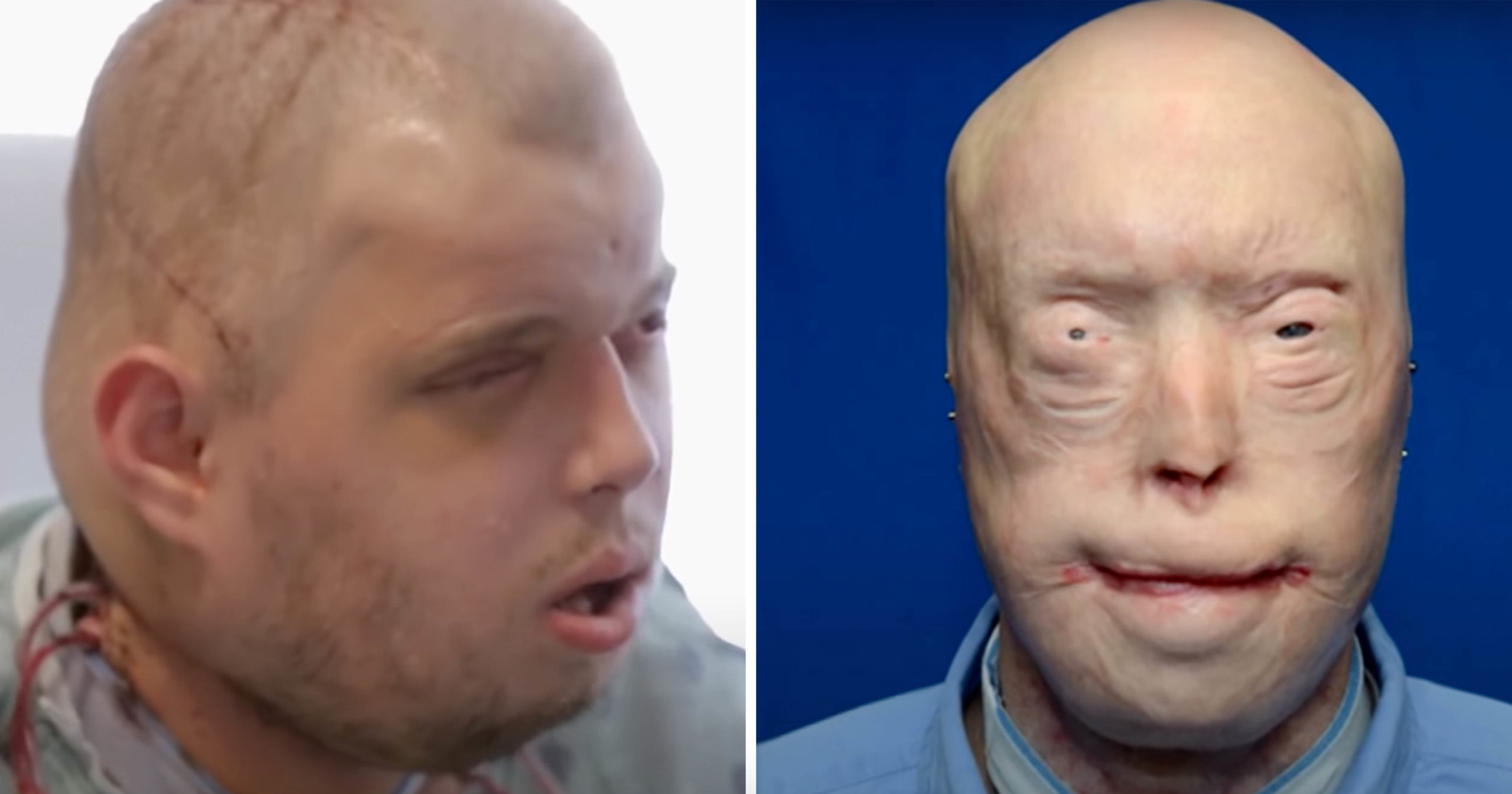 Brave firefighter has face transplant after suffering third-degree burns, and survives against all odds